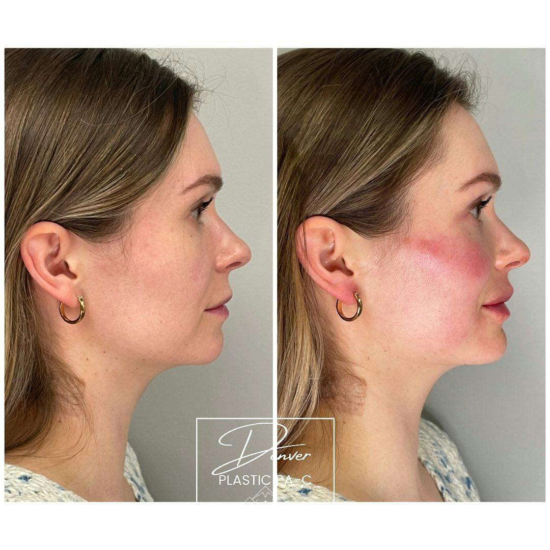 Jawline Sculpting Before & After Gallery - Patient 60780835 - Image 5