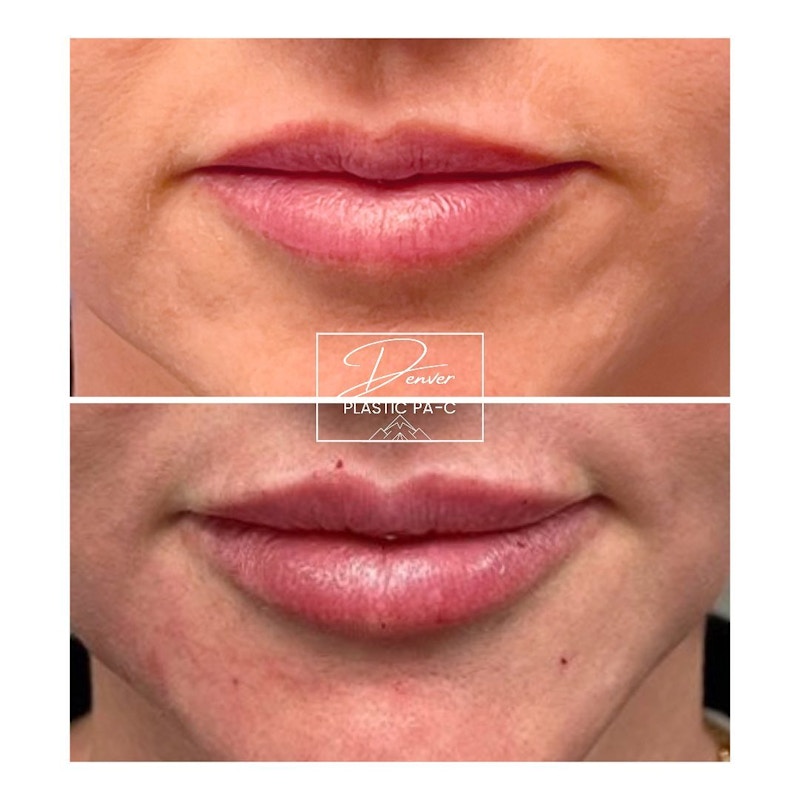 Lip Fillers Before & After Gallery - Patient 60780839 - Image 1