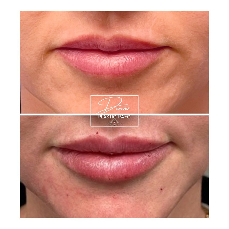 Lip Fillers Before & After Photos Page 2 Peak Plastic Surgery