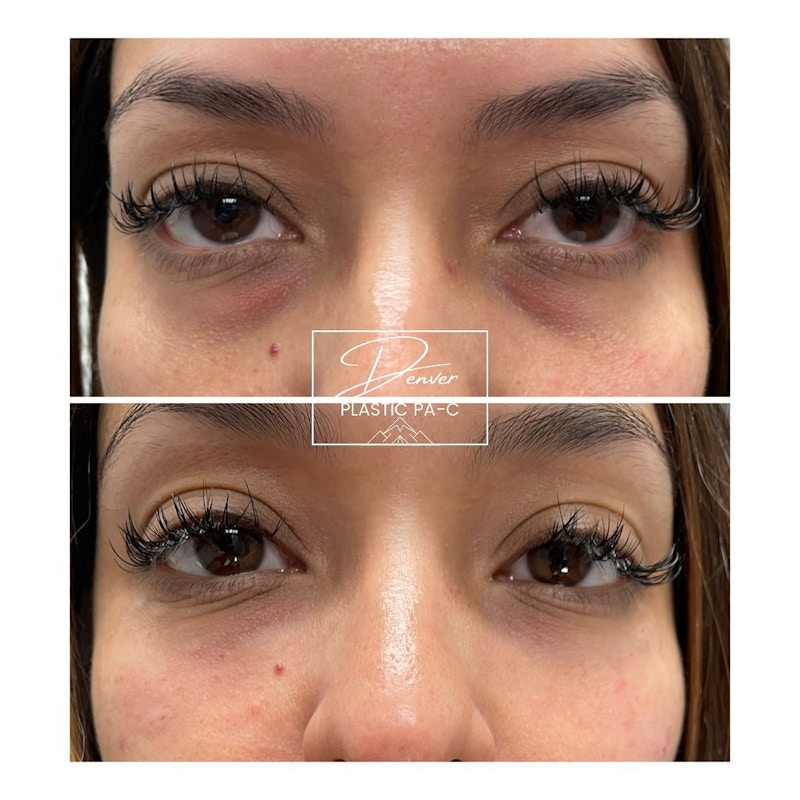 Under Eye Filler Before & After Gallery - Patient 60780850 - Image 1