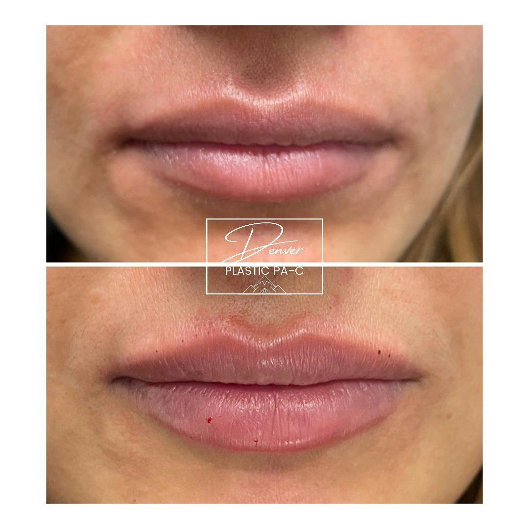 Lip Fillers Before & After Gallery - Patient 60780858 - Image 2