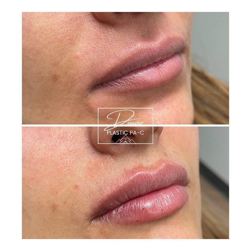 Lip Fillers Before & After Gallery - Patient 60780858 - Image 1