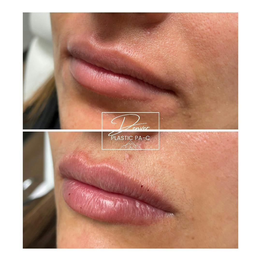 Lip Fillers Before & After Gallery - Patient 60780858 - Image 3