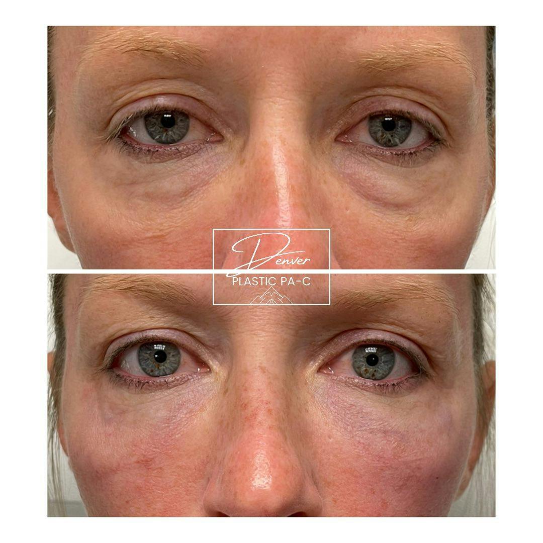 Under Eye Bags Before & After Gallery - Patient 60780863 - Image 1