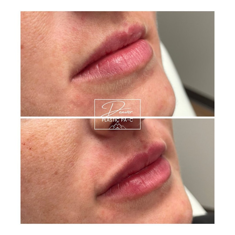 Lip Fillers Before & After Gallery - Patient 60780867 - Image 1