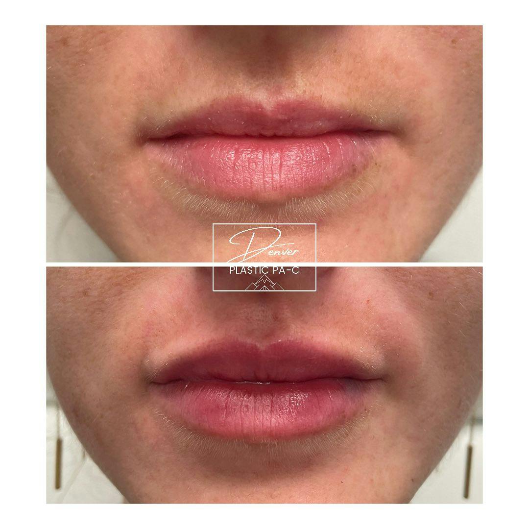 Lip Fillers Before & After Gallery - Patient 60780867 - Image 2