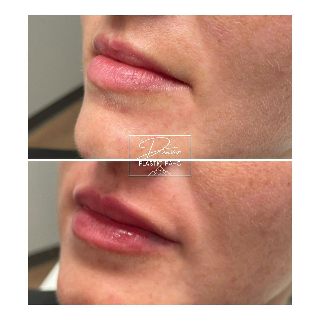 Lip Fillers Before & After Gallery - Patient 60780867 - Image 3