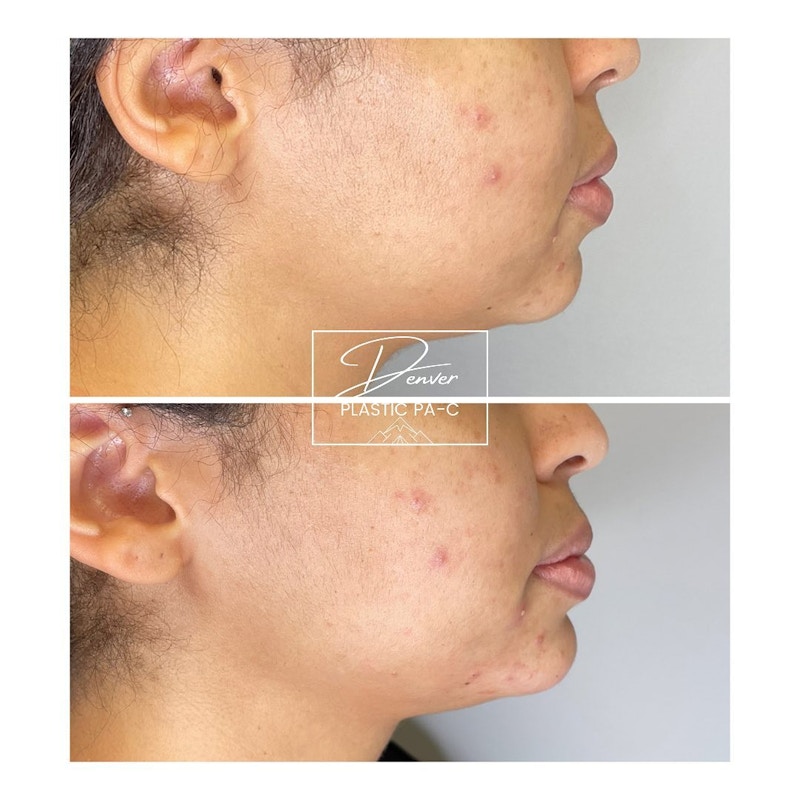 Jawline Sculpting Before & After Gallery - Patient 60780872 - Image 1