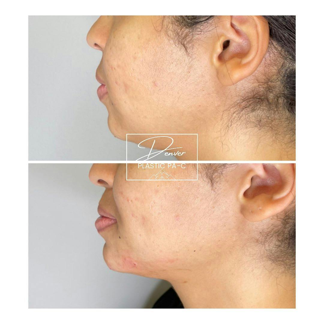 Jawline Sculpting Before & After Gallery - Patient 60780872 - Image 2