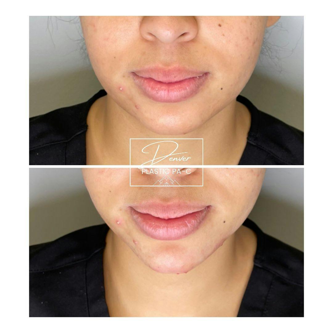 Jawline Sculpting Before & After Gallery - Patient 60780872 - Image 3