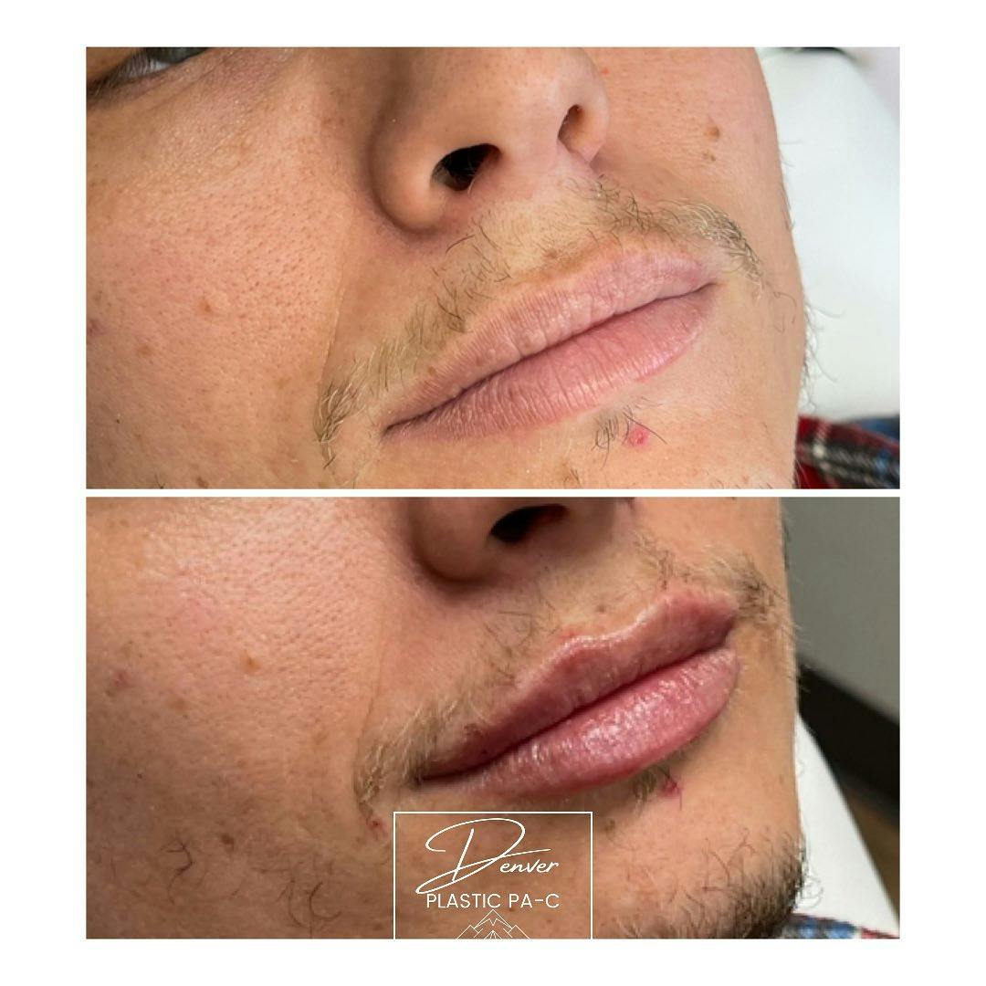 RHA® Fillers Before & After Gallery - Patient 60780878 - Image 3