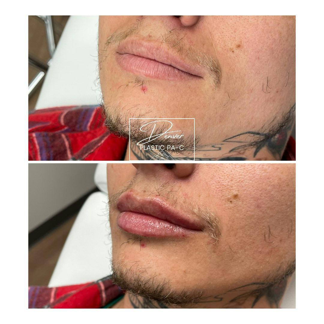 RHA® Fillers Before & After Gallery - Patient 60780878 - Image 2