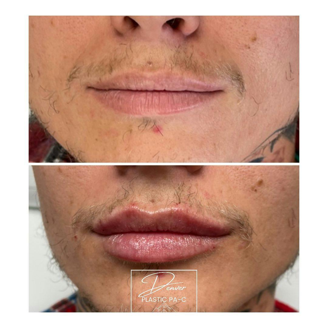 Lip Fillers Before & After Gallery - Patient 60780877 - Image 3