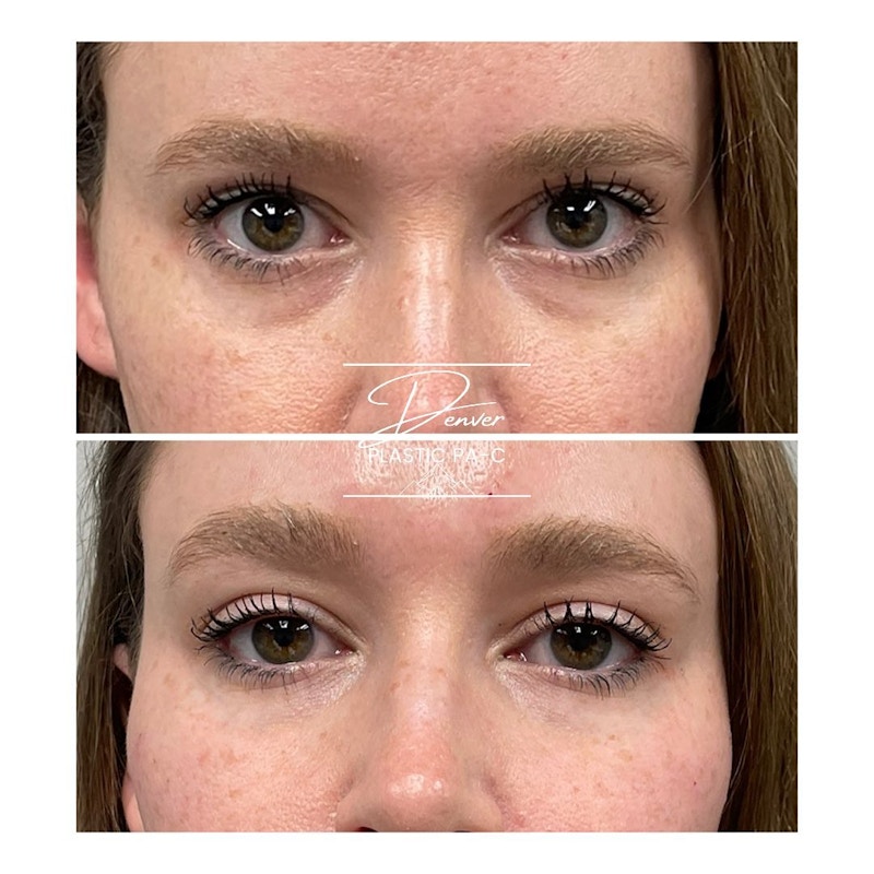 Under Eye Filler Before & After Gallery - Patient 60780887 - Image 1