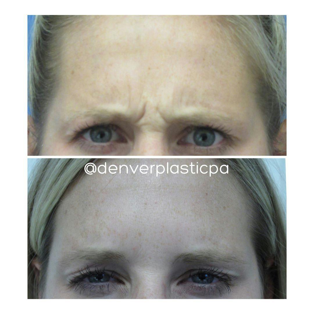 BOTOX®/Dysport Before & After Gallery - Patient 60780890 - Image 2