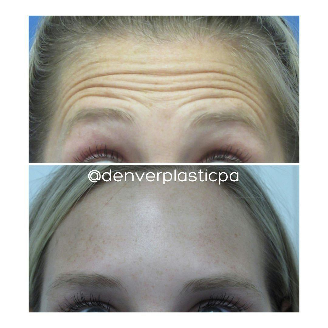 BOTOX®/Dysport Before & After Gallery - Patient 60780890 - Image 1
