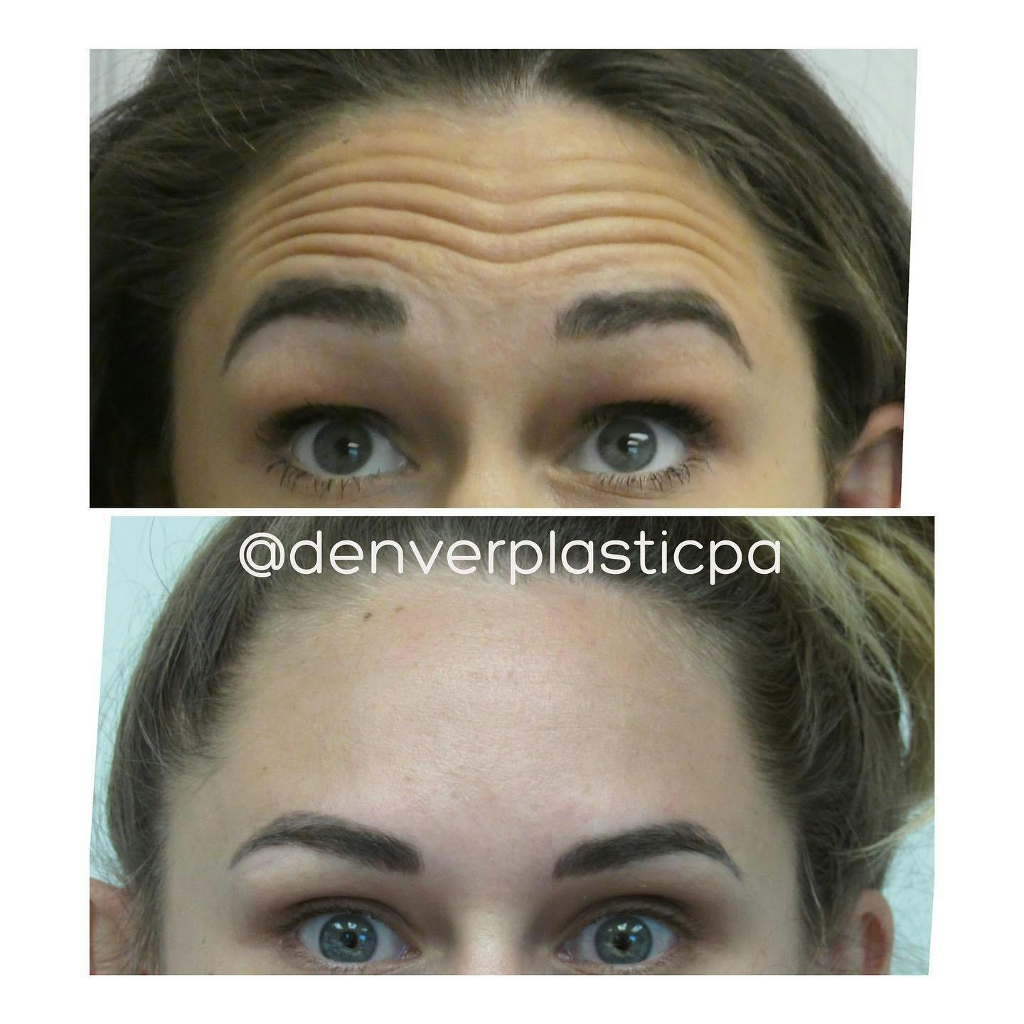 BOTOX®/Dysport Before & After Gallery - Patient 60780908 - Image 1