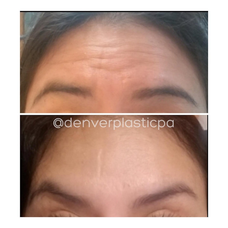 BOTOX®/Dysport Before & After Gallery - Patient 60838010 - Image 1