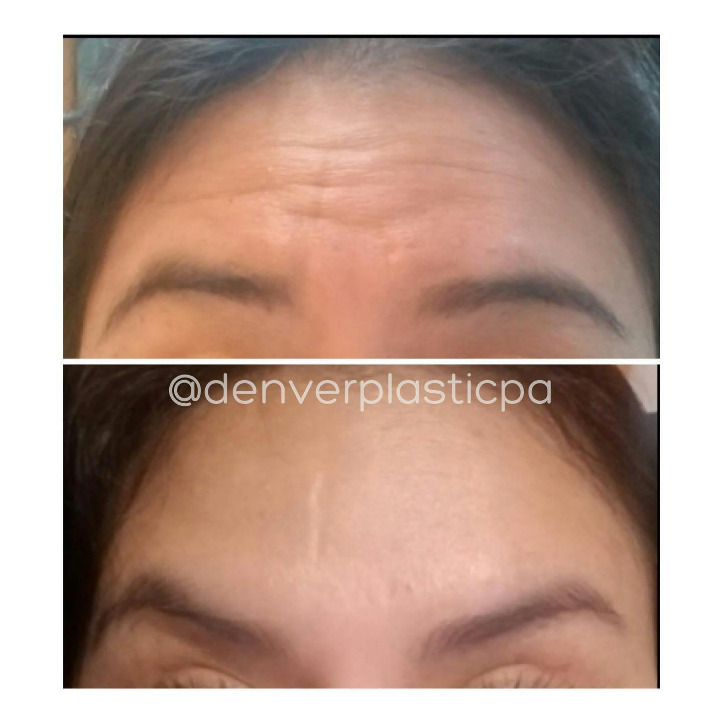 BOTOX®/Dysport Before & After Gallery - Patient 60838010 - Image 1