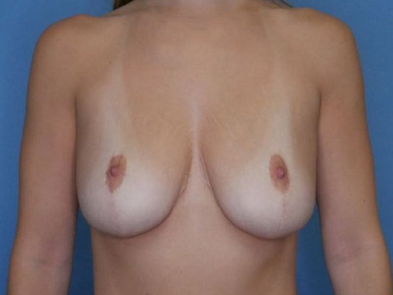 Breast Augmentation Before & After Gallery - Patient 66591775 - Image 1
