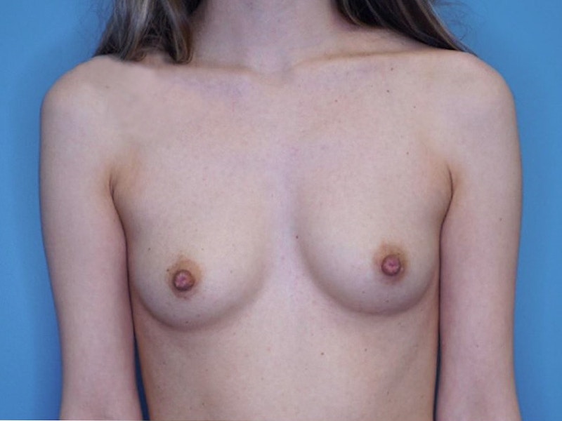 Breast Augmentation Before & After Gallery - Patient 66591776 - Image 1