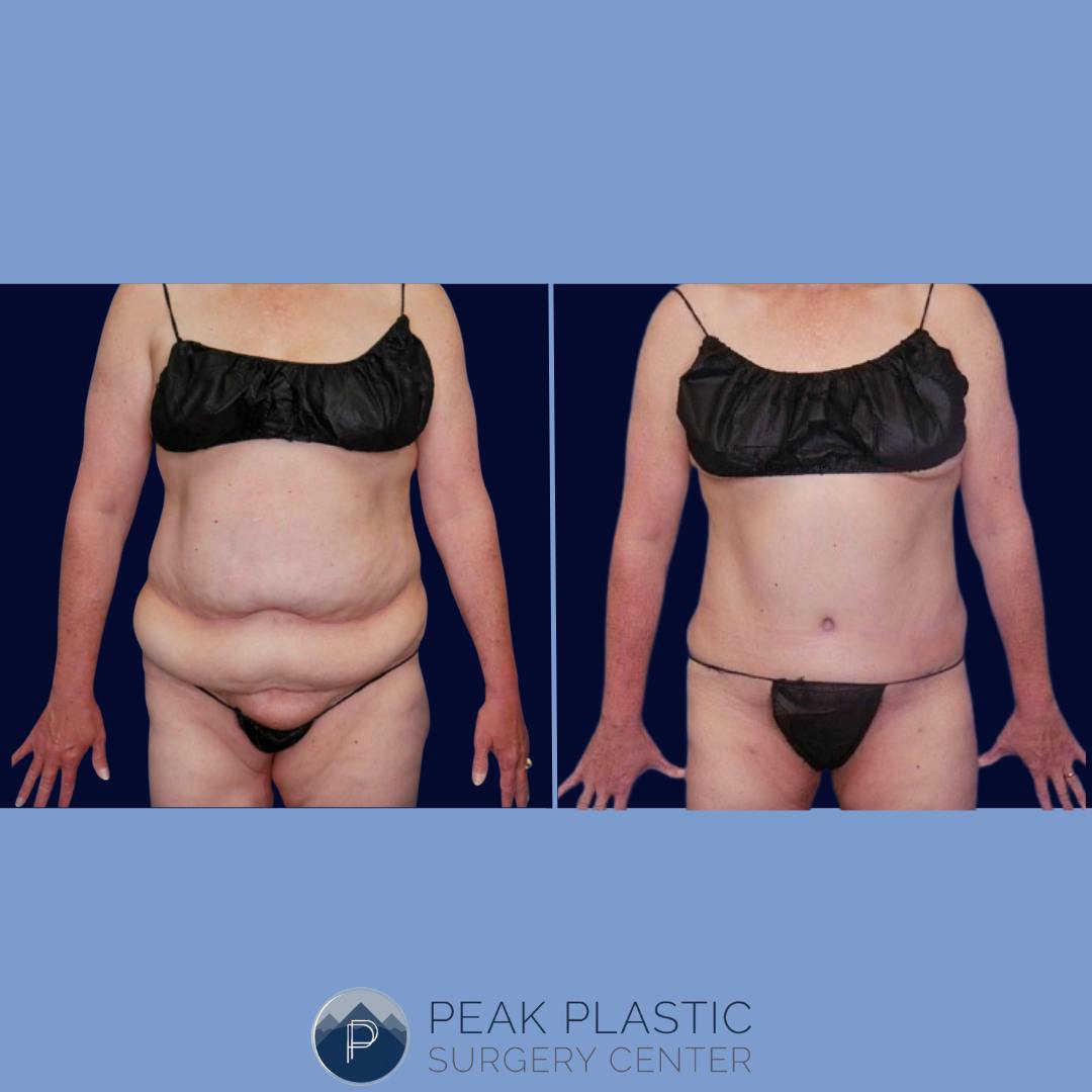 Tummy Tuck (Abdominoplasty)  Before & After Gallery - Patient 66595215 - Image 1