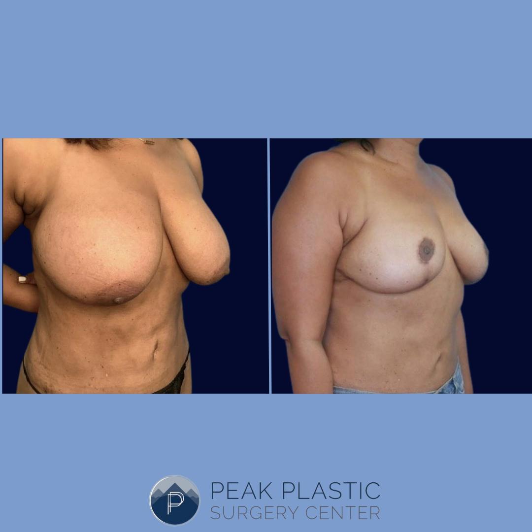 Breast Reduction Before & After Gallery - Patient 66598571 - Image 2