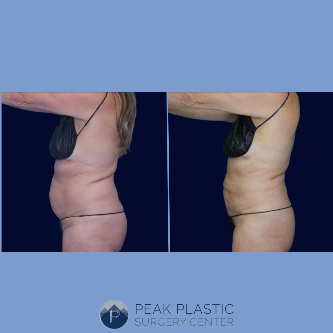 Vaser Liposuction Before & After Gallery - Patient 66598620 - Image 1
