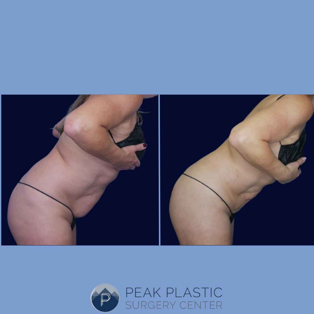 Vaser Liposuction Before & After Gallery - Patient 66598620 - Image 2
