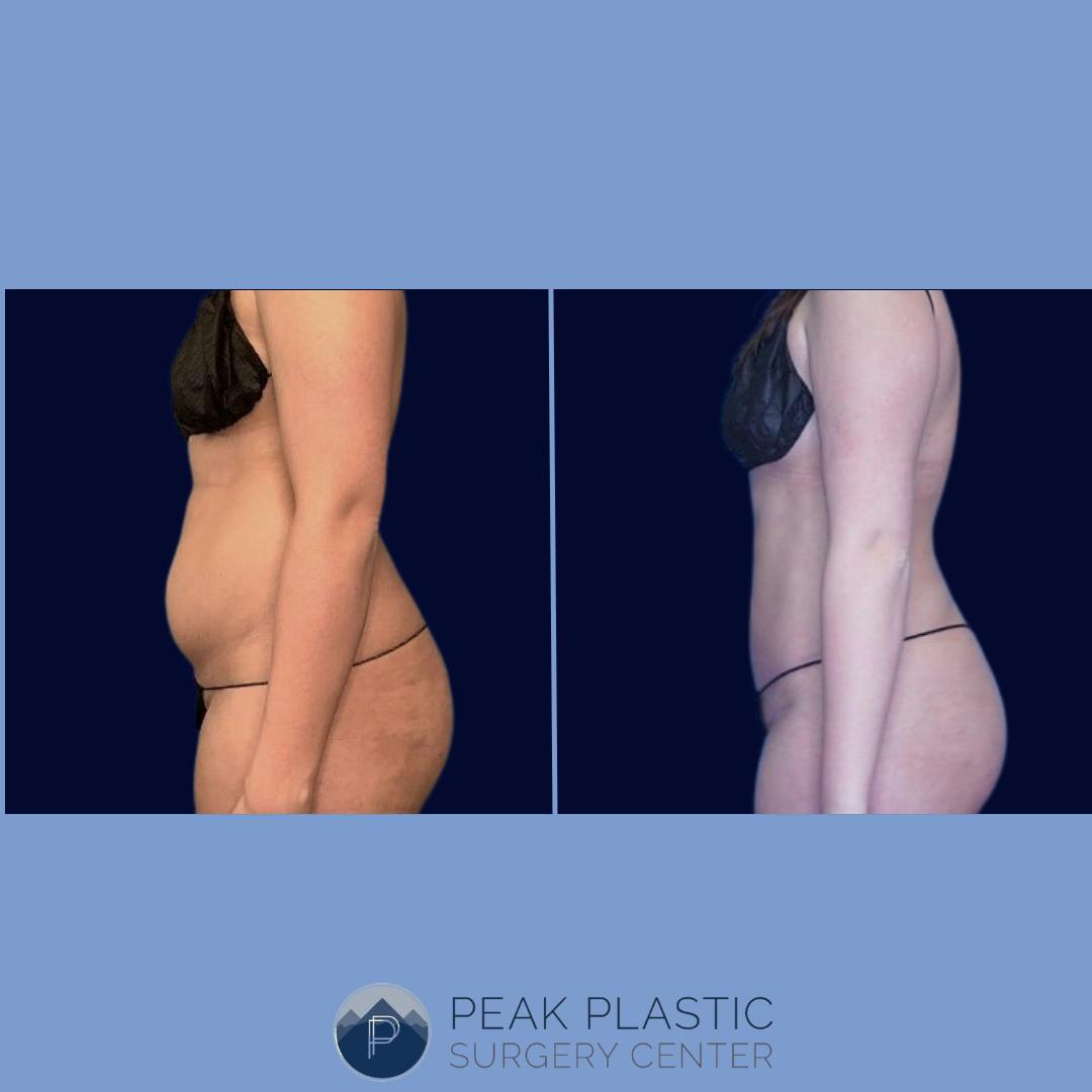 Vaser Liposuction Before & After Gallery - Patient 66598621 - Image 1