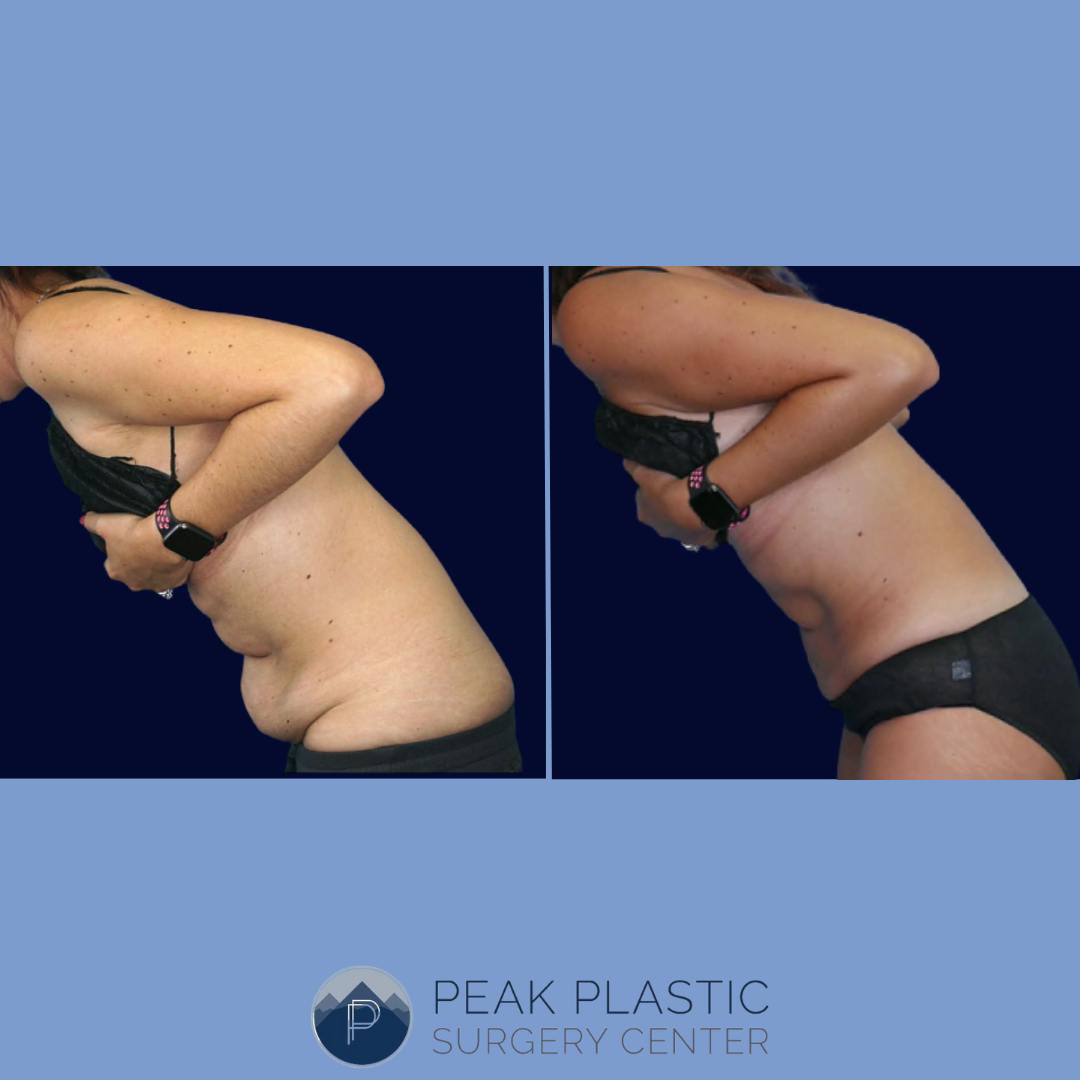 Vaser Liposuction Before & After Gallery - Patient 66598621 - Image 2
