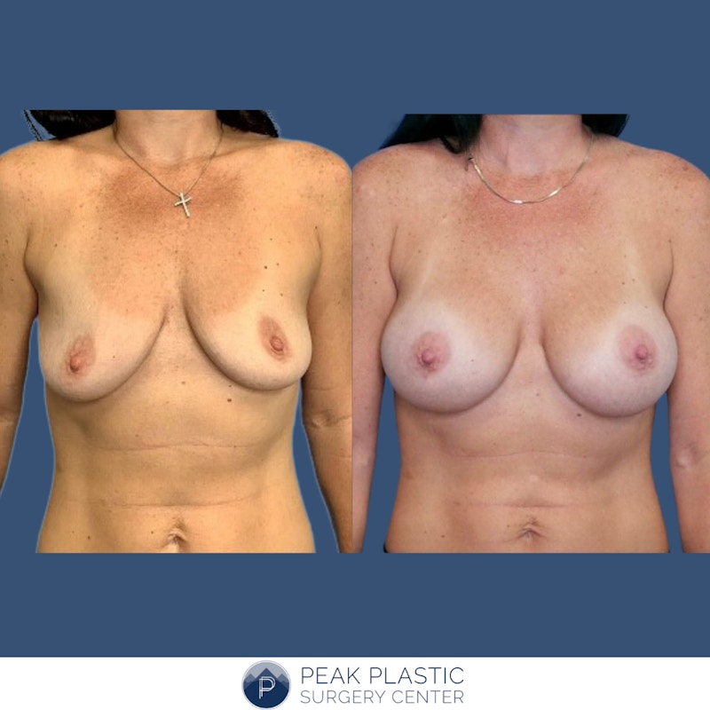 Breast Augmentation Before & After Gallery - Patient 69797684 - Image 1