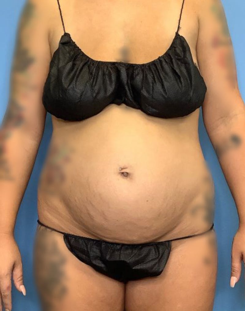 Vaser Liposuction Before & After Gallery - Patient 76667870 - Image 1