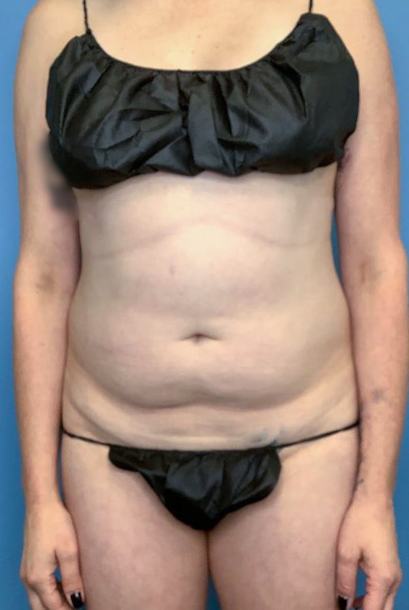 Vaser Liposuction Before & After Gallery - Patient 76667885 - Image 1