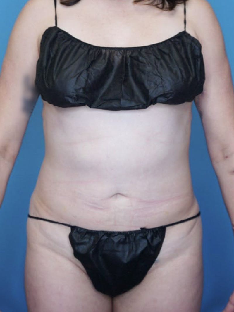 Vaser Liposuction Before & After Gallery - Patient 76667885 - Image 2