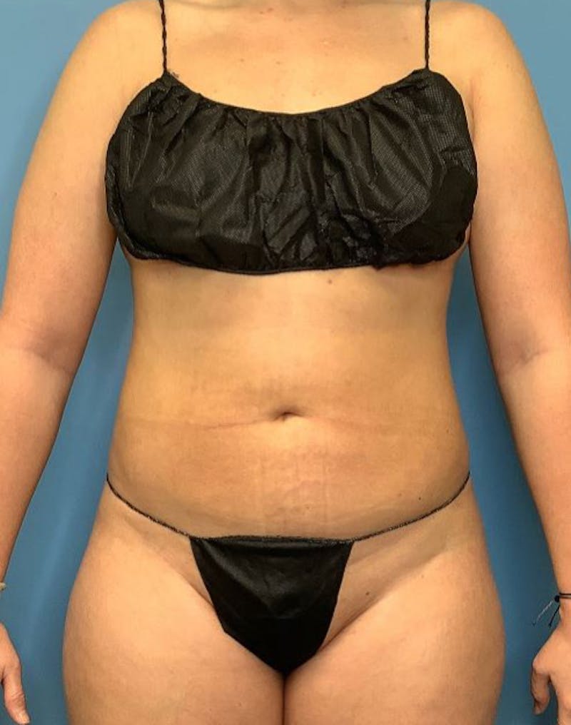 Vaser Liposuction Before & After Gallery - Patient 76667896 - Image 2