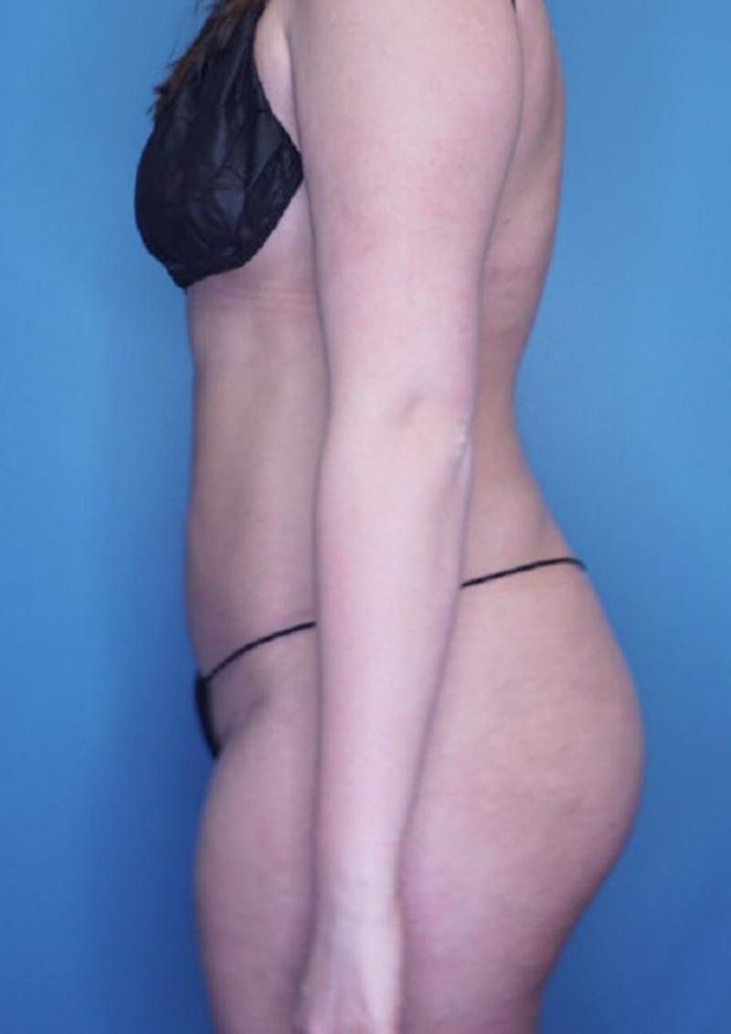 Vaser Liposuction Before & After Gallery - Patient 76667896 - Image 4
