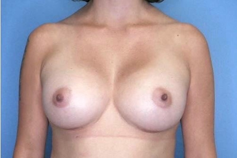 Breast Augmentation Before & After Gallery - Patient 77477323 - Image 2