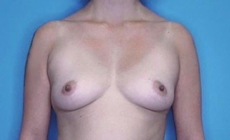 Breast Augmentation Before & After Gallery - Patient 77477323 - Image 1