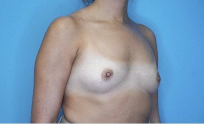 Breast Augmentation Before & After Gallery - Patient 77479284 - Image 3