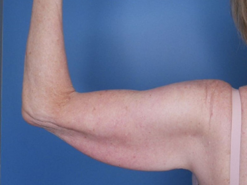 Arm Lift (Brachioplasty)  Before & After Gallery - Patient 77821741 - Image 1