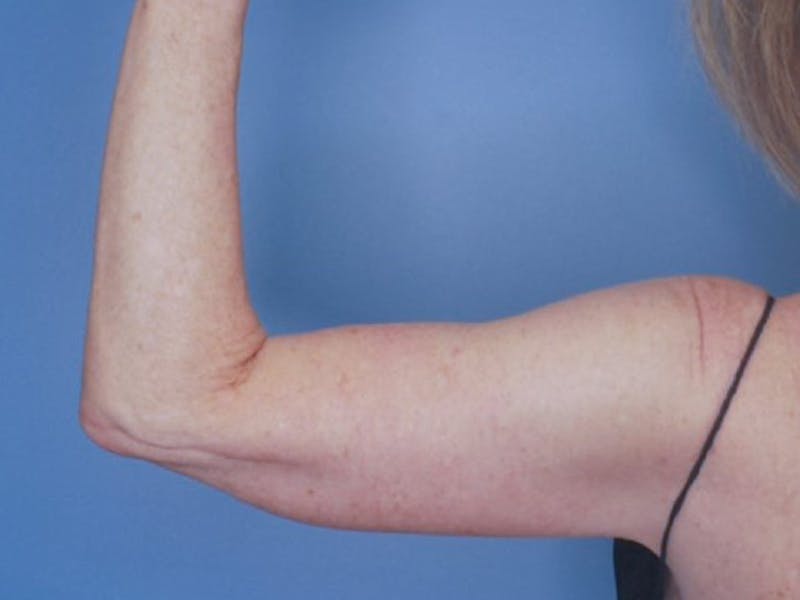 Arm Lift (Brachioplasty)  Before & After Gallery - Patient 77821741 - Image 2