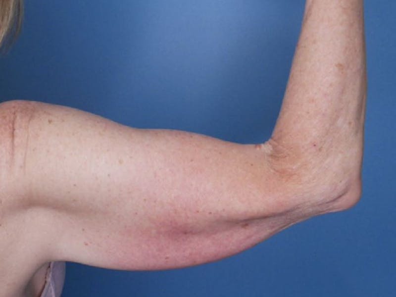 Arm Lift (Brachioplasty)  Before & After Gallery - Patient 77821741 - Image 3