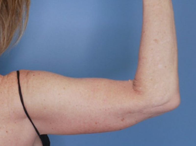 Arm Lift (Brachioplasty)  Before & After Gallery - Patient 77821741 - Image 4