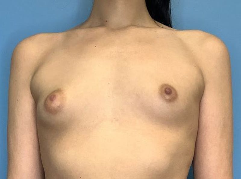 Breast Augmentation Before & After Gallery - Patient 77849550 - Image 1