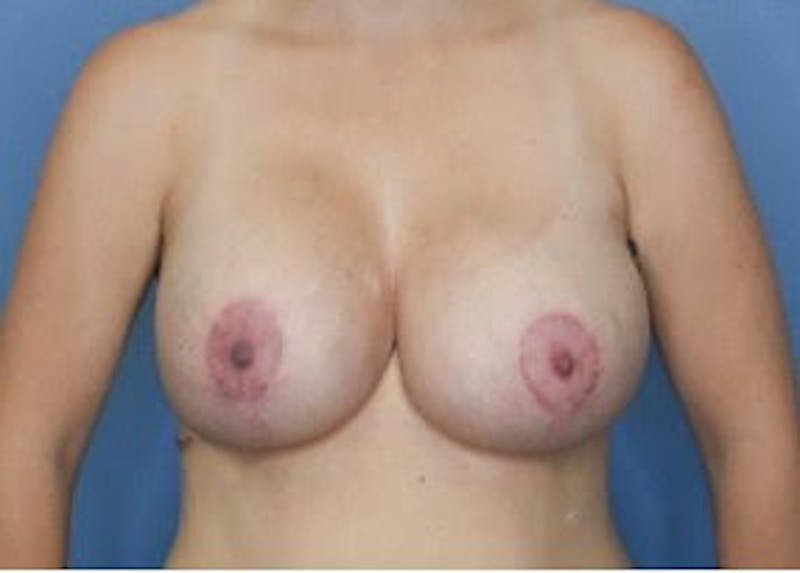 Breast Augmentation Before & After Gallery - Patient 79311777 - Image 4