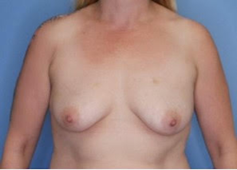 Breast Augmentation Before & After Gallery - Patient 79321588 - Image 1