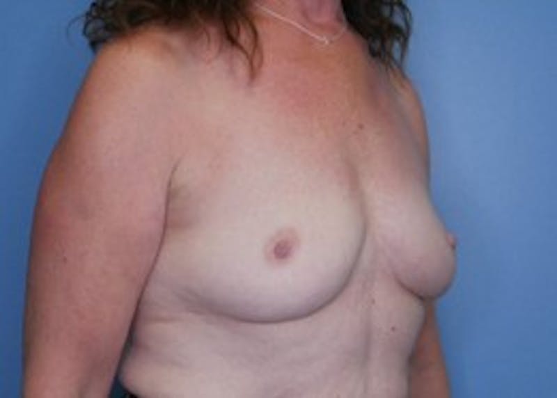 Breast Augmentation Before & After Gallery - Patient 83307256 - Image 3