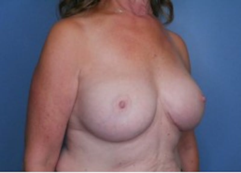 Breast Augmentation Before & After Gallery - Patient 83307256 - Image 4