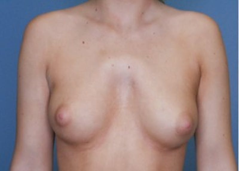 Breast Augmentation Before & After Gallery - Patient 83307257 - Image 1